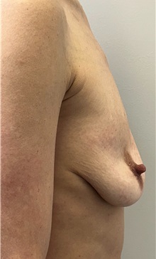 Breast Lift Before Photo by Mark McRae, MD, FRCS(C); Burlington, ON - Case 49366