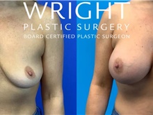 Breast Augmentation After Photo by Eric Wright, MD; Little Rock, AR - Case 47417