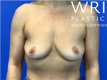Breast Augmentation Before Photo by Eric Wright, MD; Little Rock, AR - Case 47417