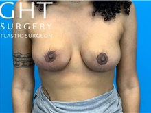 Breast Lift After Photo by Eric Wright, MD; Little Rock, AR - Case 47418