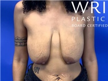 Breast Lift Before Photo by Eric Wright, MD; Little Rock, AR - Case 47418