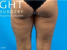 Liposuction After Photo by Eric Wright, MD; Little Rock, AR - Case 47419