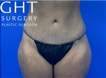 Tummy Tuck After Photo by Eric Wright, MD; Little Rock, AR - Case 47425
