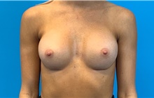Breast Augmentation After Photo by Eric Wright, MD; Little Rock, AR - Case 48563