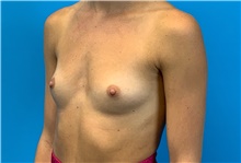 Breast Augmentation Before Photo by Eric Wright, MD; Little Rock, AR - Case 48563