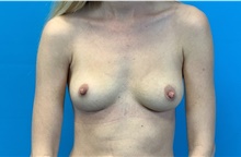 Breast Implant Removal After Photo by Eric Wright, MD; Little Rock, AR - Case 48564