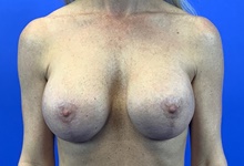 Breast Implant Revision After Photo by Eric Wright, MD; Little Rock, AR - Case 48565