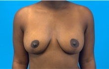 Breast Lift After Photo by Eric Wright, MD; Little Rock, AR - Case 48566