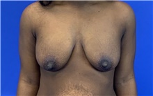 Breast Lift Before Photo by Eric Wright, MD; Little Rock, AR - Case 48566