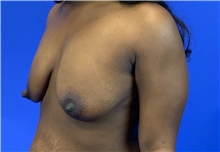 Breast Lift Before Photo by Eric Wright, MD; Little Rock, AR - Case 48566