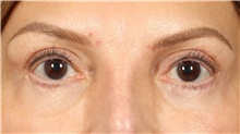 Eyelid Surgery After Photo by Eric Wright, MD; Little Rock, AR - Case 48568