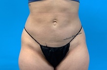 Liposuction After Photo by Eric Wright, MD; Little Rock, AR - Case 48570