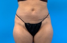 Liposuction Before Photo by Eric Wright, MD; Little Rock, AR - Case 48570