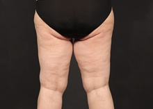 Thigh Lift After Photo by Eric Wright, MD; Little Rock, AR - Case 48571