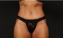 Tummy Tuck After Photo by Eric Wright, MD; Little Rock, AR - Case 48572