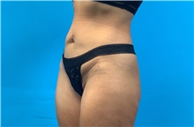 Tummy Tuck Before Photo by Eric Wright, MD; Little Rock, AR - Case 48572