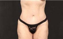 Tummy Tuck After Photo by Eric Wright, MD; Little Rock, AR - Case 48573