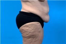 Tummy Tuck Before Photo by Eric Wright, MD; Little Rock, AR - Case 48573
