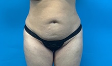 Tummy Tuck Before Photo by Eric Wright, MD; Little Rock, AR - Case 48574