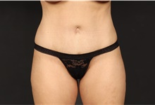 Tummy Tuck After Photo by Eric Wright, MD; Little Rock, AR - Case 48579