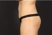 Tummy Tuck After Photo by Eric Wright, MD; Little Rock, AR - Case 48579