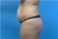 Tummy Tuck Before Photo by Eric Wright, MD; Little Rock, AR - Case 48579