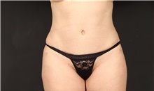 Tummy Tuck After Photo by Eric Wright, MD; Little Rock, AR - Case 48580