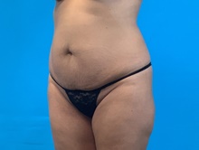 Tummy Tuck Before Photo by Eric Wright, MD; Little Rock, AR - Case 48580