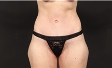Tummy Tuck After Photo by Eric Wright, MD; Little Rock, AR - Case 48581