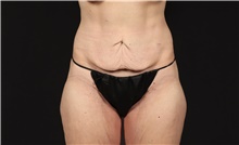 Tummy Tuck Before Photo by Eric Wright, MD; Little Rock, AR - Case 48581