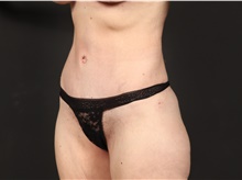 Tummy Tuck After Photo by Eric Wright, MD; Little Rock, AR - Case 48581
