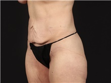 Tummy Tuck Before Photo by Eric Wright, MD; Little Rock, AR - Case 48581