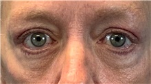Eyelid Surgery After Photo by Eric Wright, MD; Little Rock, AR - Case 48582