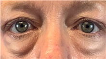 Eyelid Surgery Before Photo by Eric Wright, MD; Little Rock, AR - Case 48582