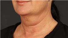 Facelift Before Photo by Eric Wright, MD; Little Rock, AR - Case 48583