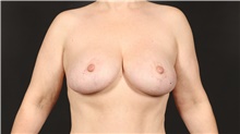 Breast Lift After Photo by Eric Wright, MD; Little Rock, AR - Case 48585