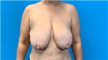 Breast Lift Before Photo by Eric Wright, MD; Little Rock, AR - Case 48585