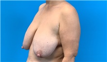 Breast Lift Before Photo by Eric Wright, MD; Little Rock, AR - Case 48585