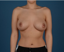 Breast Augmentation After Photo by Geo Tabbal, M.D.; Frisco, TX - Case 46268