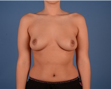 Breast Augmentation Before Photo by Geo Tabbal, M.D.; Frisco, TX - Case 46268