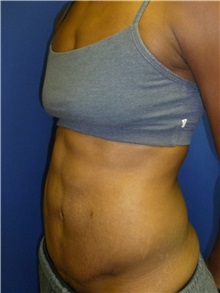 Liposuction After Photo by Mark Markarian, MD, MSPH, FACS; Wellesley, MA - Case 31768