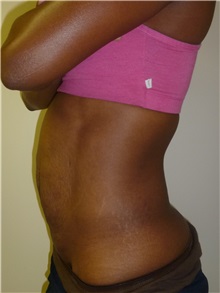 Liposuction Before Photo by Mark Markarian, MD, MSPH, FACS; Wellesley, MA - Case 31768