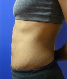 Liposuction After Photo by Mark Markarian, MD, MSPH, FACS; Wellesley, MA - Case 31768