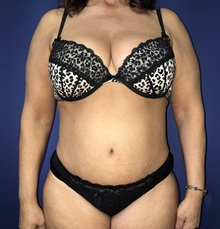 Tummy Tuck After Photo by Mark Markarian, MD, MSPH, FACS; Wellesley, MA - Case 31808