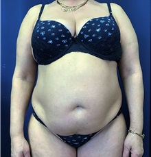 Tummy Tuck Before Photo by Mark Markarian, MD, MSPH, FACS; Wellesley, MA - Case 31808