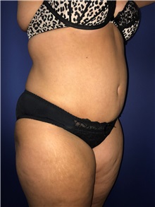 Tummy Tuck After Photo by Mark Markarian, MD, MSPH, FACS; Wellesley, MA - Case 31808