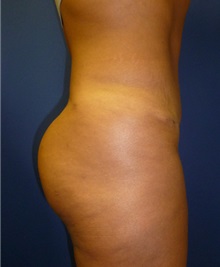 Buttock Lift with Augmentation After Photo by Mark Markarian, MD, MSPH, FACS; Wellesley, MA - Case 31809