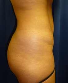 Buttock Lift with Augmentation Before Photo by Mark Markarian, MD, MSPH, FACS; Wellesley, MA - Case 31809