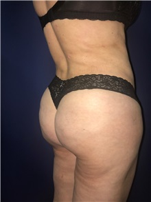 Buttock Lift with Augmentation After Photo by Mark Markarian, MD, MSPH, FACS; Wellesley, MA - Case 31810