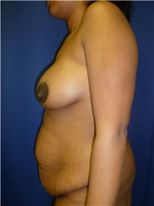 Breast Lift Before Photo by Mark Markarian, MD, MSPH, FACS; Wellesley, MA - Case 31812